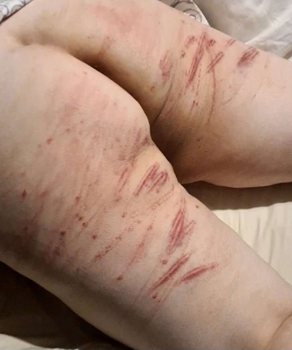 Taylor_Minor90's tweet photo. Ouchie day yesterday... And I can still feel it today!! https://t.co/ZqSw6b2E5j