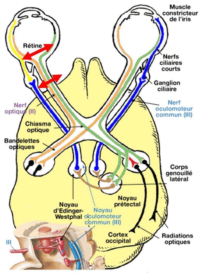 La mydriase / anisocorie en neuro-réa: ça vient d'où ? Ca veut dire ...
