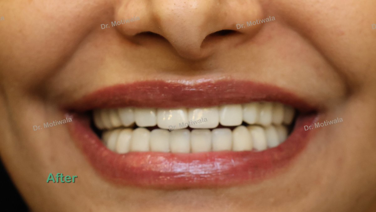 drmotiwaladcic's tweet photo. Smile makeover in 5 days
Smile designing followed by full mouth zirconia crowns!
#zirconiacrownsandbridges #cosmeticdentistry #dentalimplants #smilemakeover #smiledesign #inhouselab #fullmouthrehabilitation
#hyderabad #india #australia #usa #canada #mexico #france #london https://t.co/ftzsWAeUAP