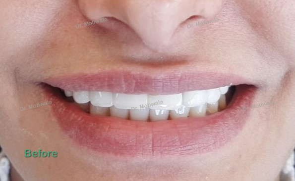 drmotiwaladcic's tweet photo. Smile makeover in 5 days
Smile designing followed by full mouth zirconia crowns!
#zirconiacrownsandbridges #cosmeticdentistry #dentalimplants #smilemakeover #smiledesign #inhouselab #fullmouthrehabilitation
#hyderabad #india #australia #usa #canada #mexico #france #london https://t.co/ftzsWAeUAP