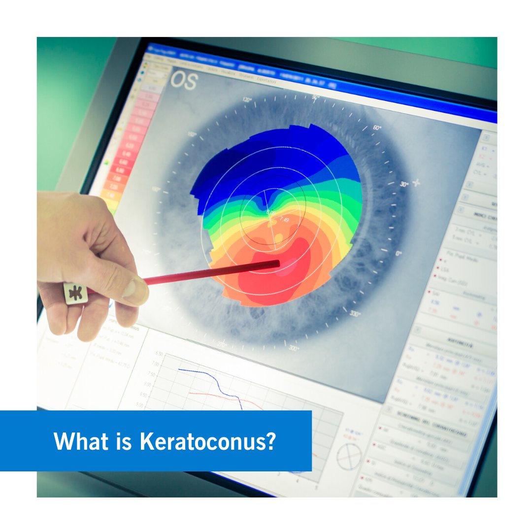 CCAD's tweet photo. Keratoconus occurs when your cornea starts to thin causing blurred vision and sensitivity to light.

Our Eye Institute is conducting research into its prevalence in the UAE, its causes, and treatment.

Click here if you'd like to participate in the study: https://t.co/knvUkOZ7BH https://t.co/OwodQf0OFZ
