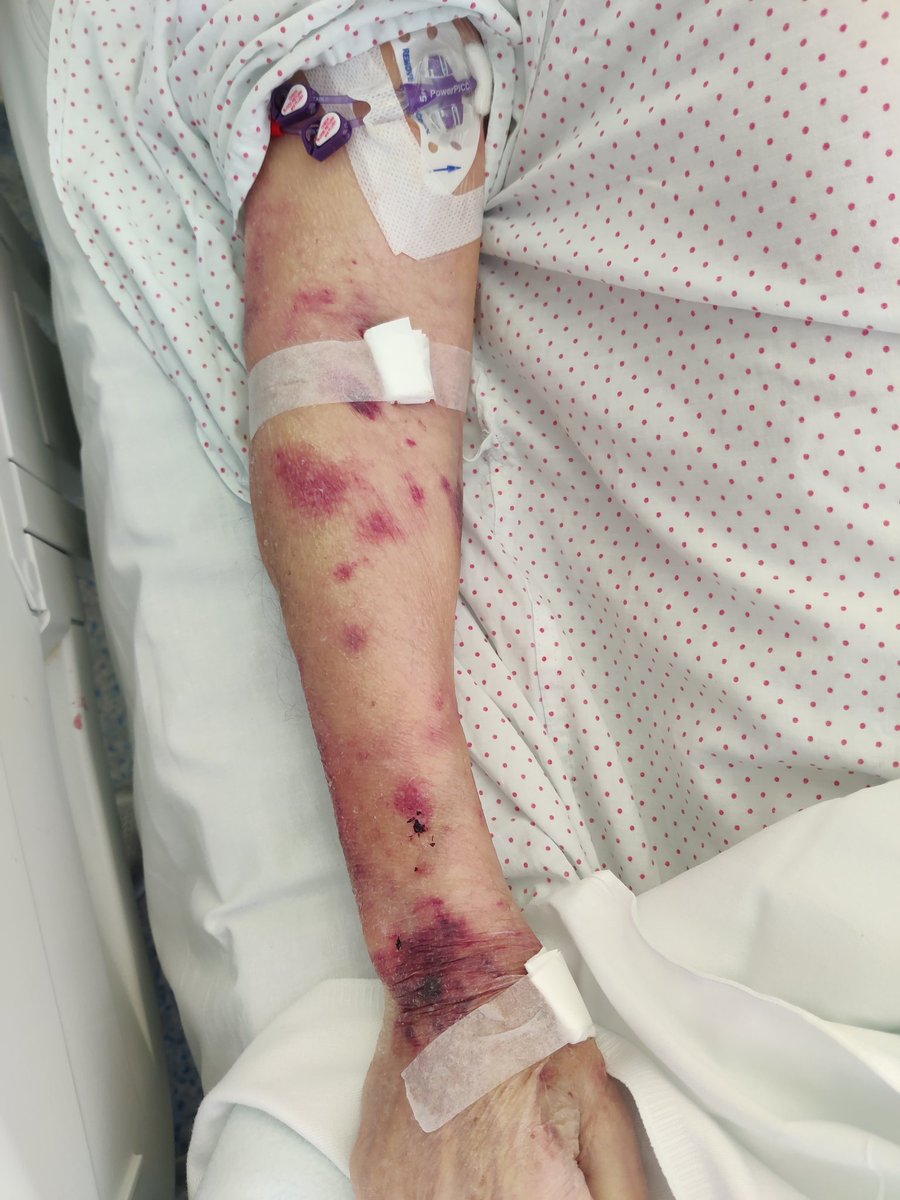 Tenemos que seguir concienciando de evitar llegar a este agotamiento vascular extremo. Cada vez somos más proactivos y cada vez se entiende mejor la necesidad de evitar una venopenia de origen iatrogenico (mala gestión).
Orgulloso del cambio de mentalidad de mis compañeros.