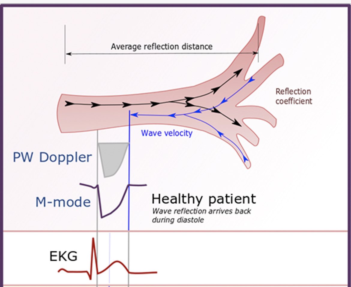 “Flying W” sign Mid systolic notching,an abrupt⬇️in antegrade systolic velocity in pulmonary artery due to poor PA capacitance &reflectance waves out of pulmonary vasculature impeding RV systolic forward flow;Can see it w pulmonary embolism also bit.ly/3DKYf3r #echofirst