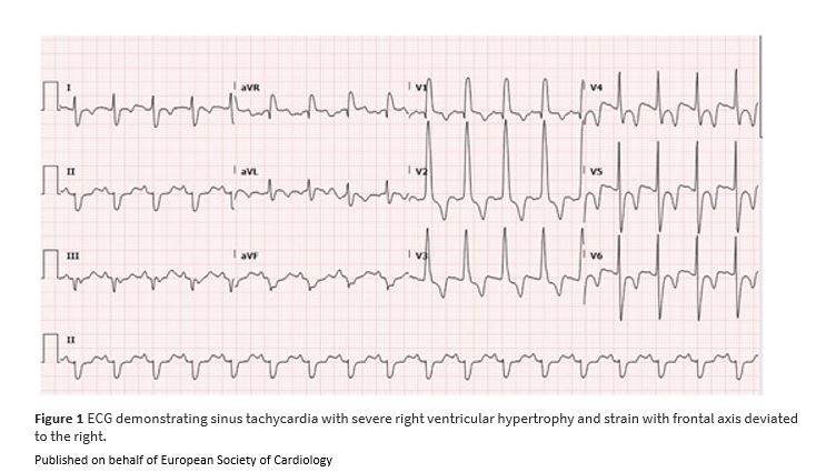 ESC_Journals's tweet image. #LostInTransition: a case report of very late palliation of a double outlet right ventricle academic.oup.com/ehjcr/article/…

#EHJCaseReports #YesCCT #ImageFirst #RadialFirst @KardiologieHH @aayshacader @ANazmiCalik @EHJCREiC @TJ_Yeo @cfcamm @FarhanaAra @HikmetKadi