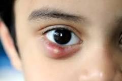 ES8pq9's tweet photo. #Ophtalmologie : Opération d'un #chalazion par d' excellents praticiens du Puy-en-Velay (Haute-Loire)
- #EmileRoux hôpital public : No problème. No dépassement d'honoraires🙂
- #BonSecours clinique privée. Même opération : 90€ de dépassement😡
Sauvons l'Hôpital #NomdeDieu! https://t.co/ZJgidzNv3x