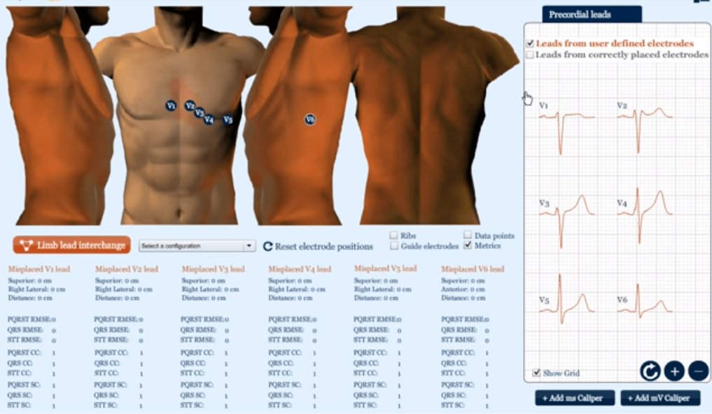 urgenciasemerge's tweet photo. 🗒️ Exposición de un caso 🗒️

🗣️ Una correcta técnica de realización del electrocardiograma es fundamental para evitar errores diagnósticos. En ocasiones somos incapaces de identificar la ubicación correcta de los electrodos V1 y V2. 😑 

💻https://t.co/aAaBV9KvIl https://t.co/gbFYIZAN4j