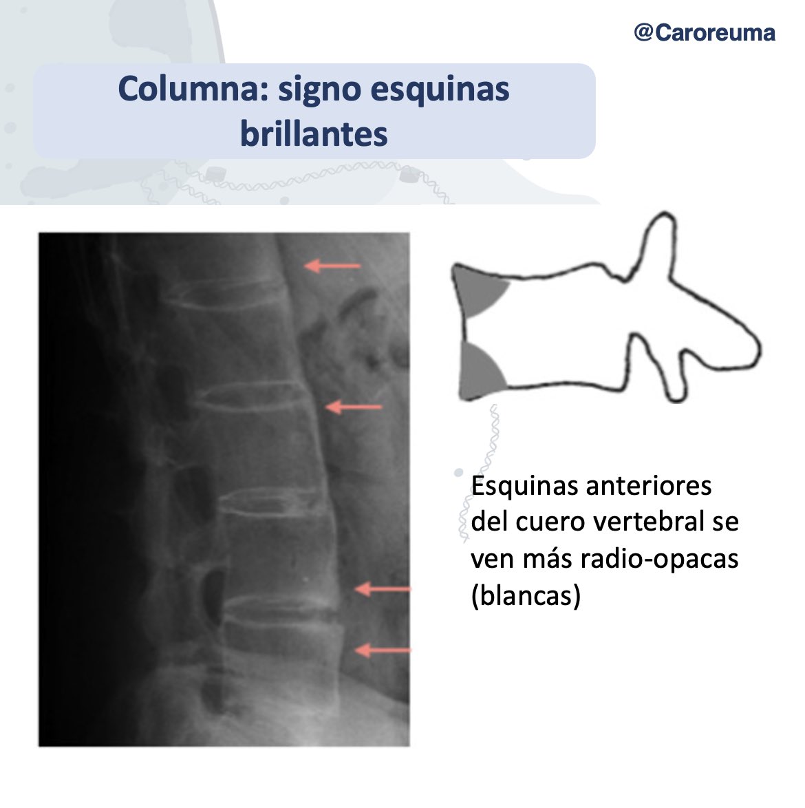 DraCaroQuintero's tweet photo. Signos radiográficos clásicos en espondilitis anquilosante 🚨parte 1 https://t.co/PgMmQneBwk