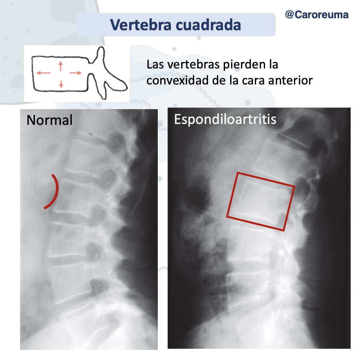 DraCaroQuintero's tweet photo. Signos radiográficos clásicos en espondilitis anquilosante 🚨parte 1 https://t.co/PgMmQneBwk