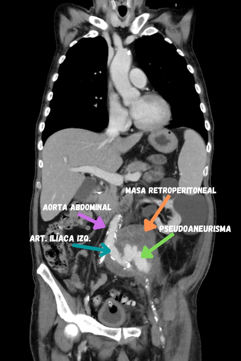 CEA_HIBA's tweet photo. ¡Imágenes interesantes para compartir!
👨‍🦲de 75 a consulta x por dolor lumboinguinal y MI izq. Ant. de de masa retroperitoneal con AP compatible con neoplasia fusocelular. ⬇️de 14 p. del hto.
AngioTC con hallazgo de pseudoaneurisma tumoral con sangrado activo. #MedEd #MedTwitter https://t.co/QPdXh8gMA6