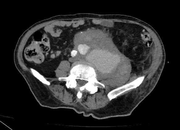 CEA_HIBA's tweet photo. ¡Imágenes interesantes para compartir!
👨‍🦲de 75 a consulta x por dolor lumboinguinal y MI izq. Ant. de de masa retroperitoneal con AP compatible con neoplasia fusocelular. ⬇️de 14 p. del hto.
AngioTC con hallazgo de pseudoaneurisma tumoral con sangrado activo. #MedEd #MedTwitter https://t.co/QPdXh8gMA6