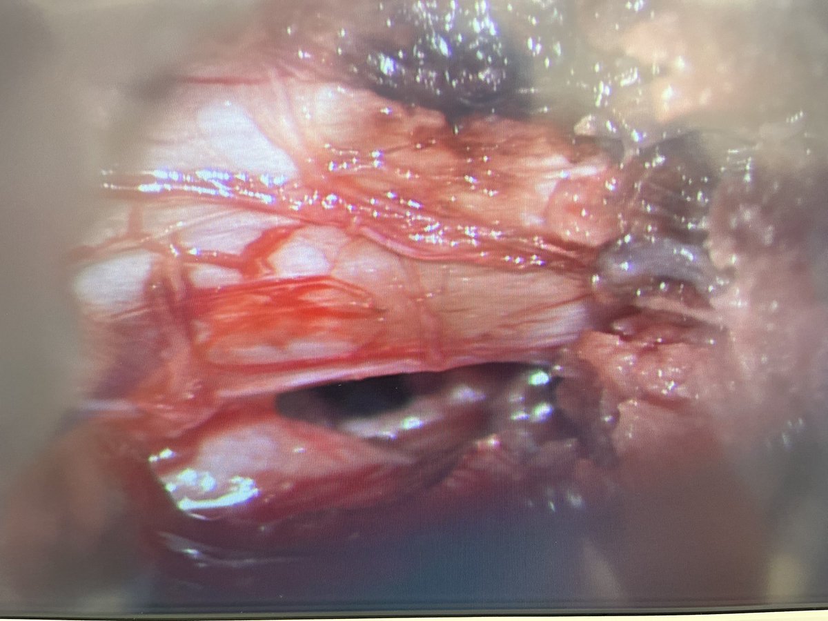 ordomd's tweet photo. MIS Tubular Discectomy for LDH has proven ⬇️ LoS, ⬇️ lumbar pain, ⬇️ blood loss &amp; ⬇️ rate of wound infection (Evaniew N et al https://t.co/cXEk7G8KMa)
This case: 1 insicion, 2 levels, 4 foramina
#NeuroTwitter #neurosurgery #spinesurgery #neuroteamcuu #lumbardischernia #spine https://t.co/E0PPYUWoy7