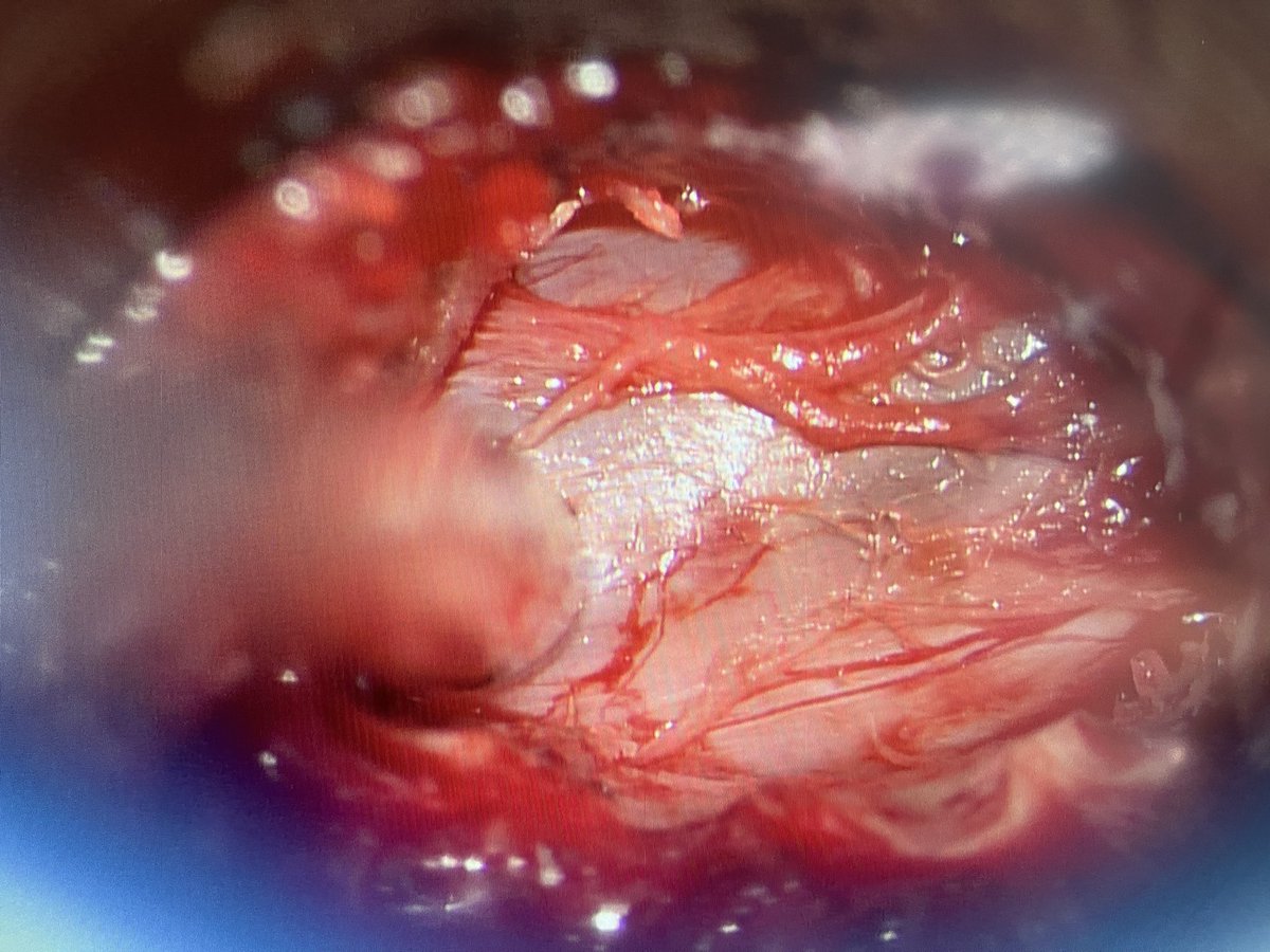 ordomd's tweet photo. MIS Tubular Discectomy for LDH has proven ⬇️ LoS, ⬇️ lumbar pain, ⬇️ blood loss &amp; ⬇️ rate of wound infection (Evaniew N et al https://t.co/cXEk7G8KMa)
This case: 1 insicion, 2 levels, 4 foramina
#NeuroTwitter #neurosurgery #spinesurgery #neuroteamcuu #lumbardischernia #spine https://t.co/E0PPYUWoy7