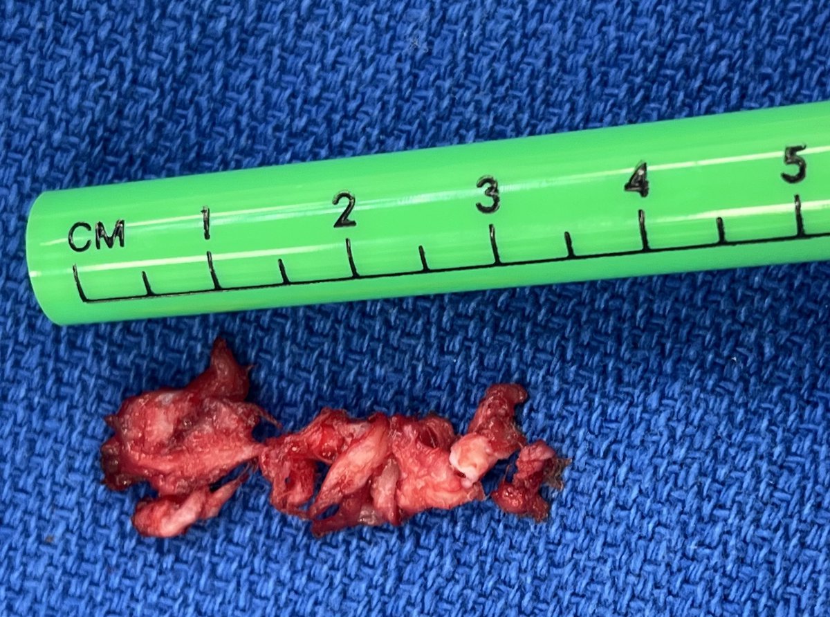 ordomd's tweet photo. MIS Tubular Discectomy for LDH has proven ⬇️ LoS, ⬇️ lumbar pain, ⬇️ blood loss &amp; ⬇️ rate of wound infection (Evaniew N et al https://t.co/cXEk7G8KMa)
This case: 1 insicion, 2 levels, 4 foramina
#NeuroTwitter #neurosurgery #spinesurgery #neuroteamcuu #lumbardischernia #spine https://t.co/E0PPYUWoy7