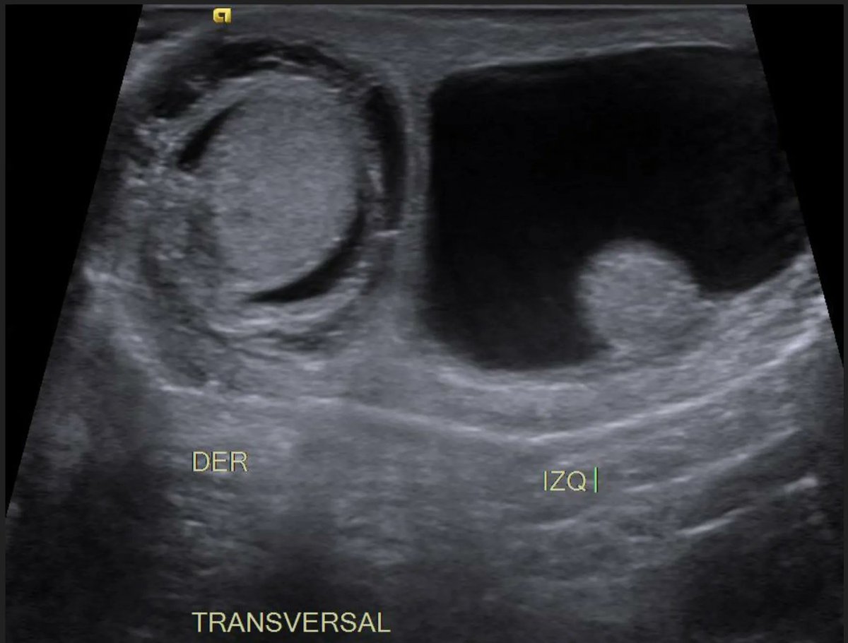myesr on Twitter "Monday is for..a new EuroRad case! ️Male newborn