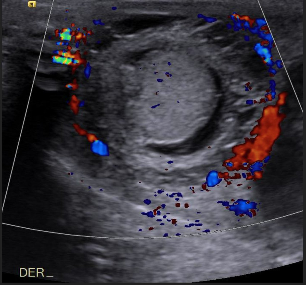 myesr on Twitter "Monday is for..a new EuroRad case! ️Male newborn