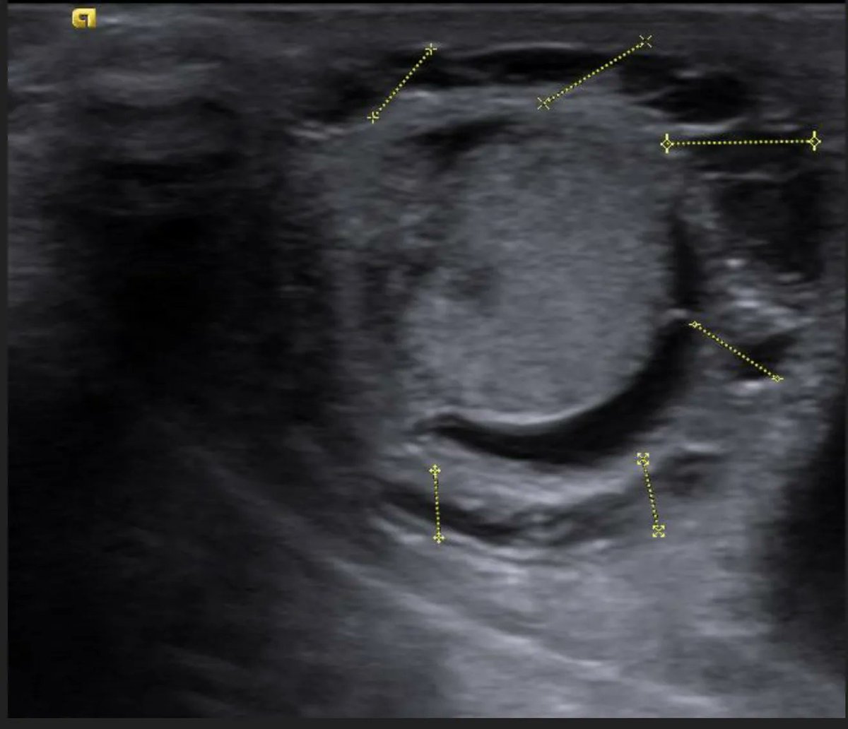 myesr on Twitter "Monday is for..a new EuroRad case! ️Male newborn