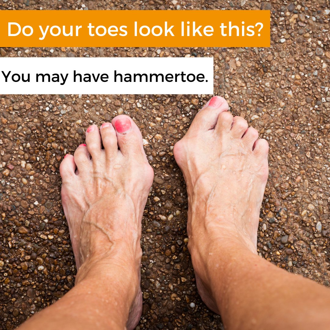 coronapodiatry's tweet photo. Do you have a #wound that refuses to heal? Are you also #diabetic? We can help you at Corona! A #footwound can be extra scary and painful for diabetics, but you don't have to deal with it alone. Schedule an appointment today.

https://t.co/HScLdcdZD8 https://t.co/rXc6p4HohE