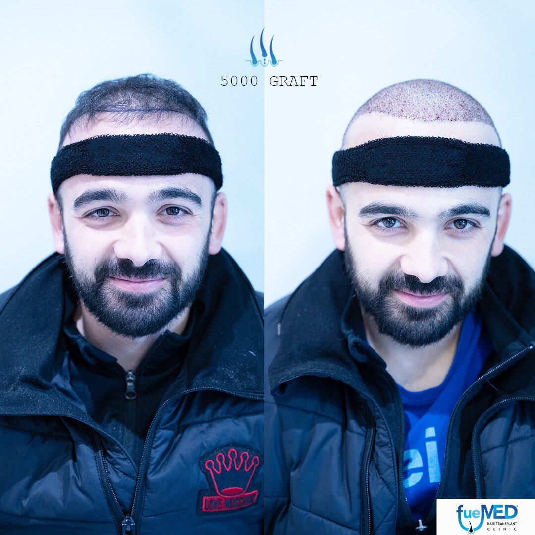 fuemedclinic's tweet image. 4500 #grafts were applied to our patient.    
Contact us !
📞 +90 549 164 90 00
✉️ info@fuemed.com
🌏 fuemed.com