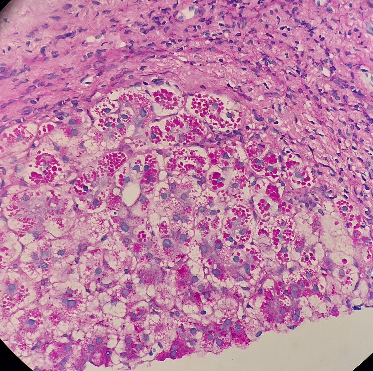 10 year old with cirrhosis.
Liver biopsy, PAS-D stain.
#liverpath #GIpath