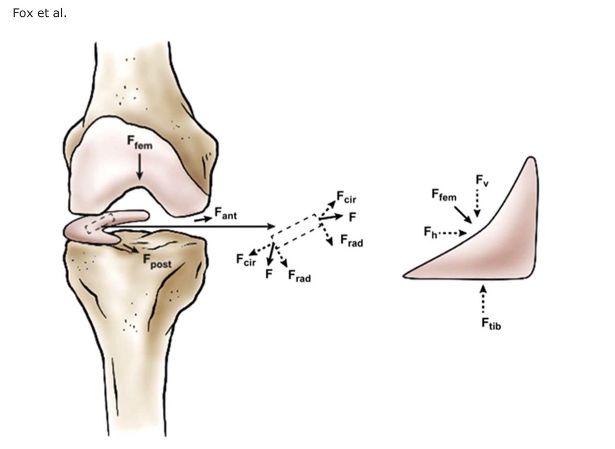 mexicosportsdoc's tweet photo. 🌙Meniscos🌙
      🧵🧵🧵

Función: 
Transmitir cargas a través de la articulación tibio-femoral aumentando su congruencia.
⬇️el estrés sobre el cartílago articular
🥊Absorción de choque (40/70% contacto fémur-tibia)
⚙️Estabilidad, lubricación, nutrición y propiocepción.
#Rodilla https://t.co/Pml1Xx8HO4