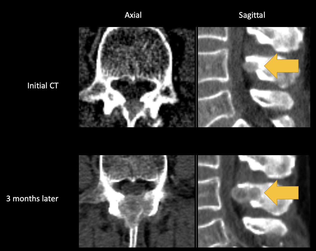 panorad_io's tweet photo. PATHFINDER - because you should learn your blindspots

Here's an RCC met to the L4 lamina on arterial-phase 
CECT that was missed on the first opportunity to identify it. https://t.co/2mAwrjPvVR