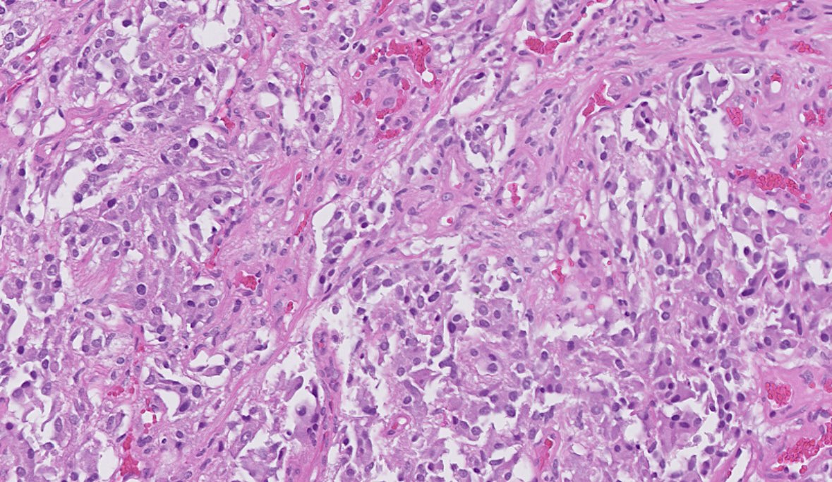 OhioStatePath's tweet photo. #pathnewbies #pathresidents
Bladder mass from a 60 year old male.
๐What is the most likely diagnosis/differential diagnosis?
๐What is the immunoprofile of this lesion?
#PathTwitter #GUPath https://t.co/9wu5rnENUV