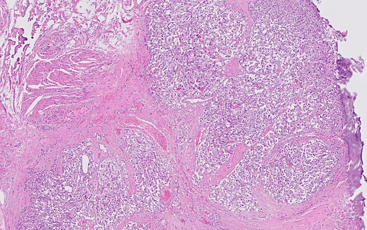 OhioStatePath's tweet photo. #pathnewbies #pathresidents
Bladder mass from a 60 year old male.
๐What is the most likely diagnosis/differential diagnosis?
๐What is the immunoprofile of this lesion?
#PathTwitter #GUPath https://t.co/9wu5rnENUV