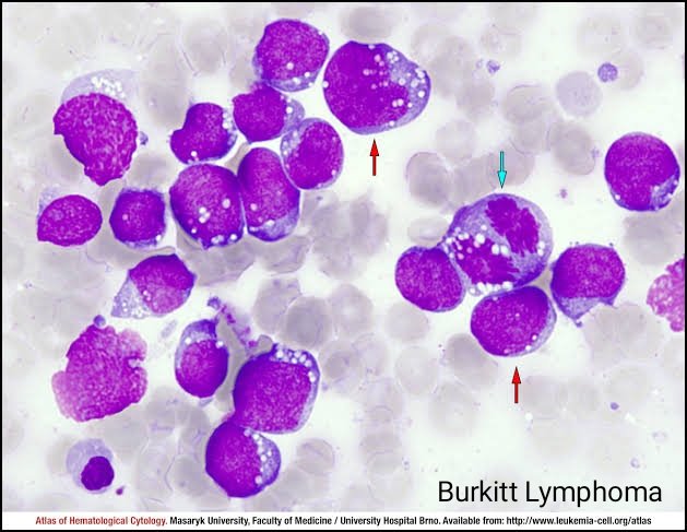 medtechlyfe's tweet image. PBS PHOTOS THAT MIGHT COME HANDY 🫣👩🏻🔬💖 For those na nagte-train to be better microscopists lalo na sa Hematology. 🥰 Everyday is a learning opportunity! (Regardless if graduate kana or working kana. It is okay do still study and learn! 💯💪🏻) #Hematology #MedtechLife