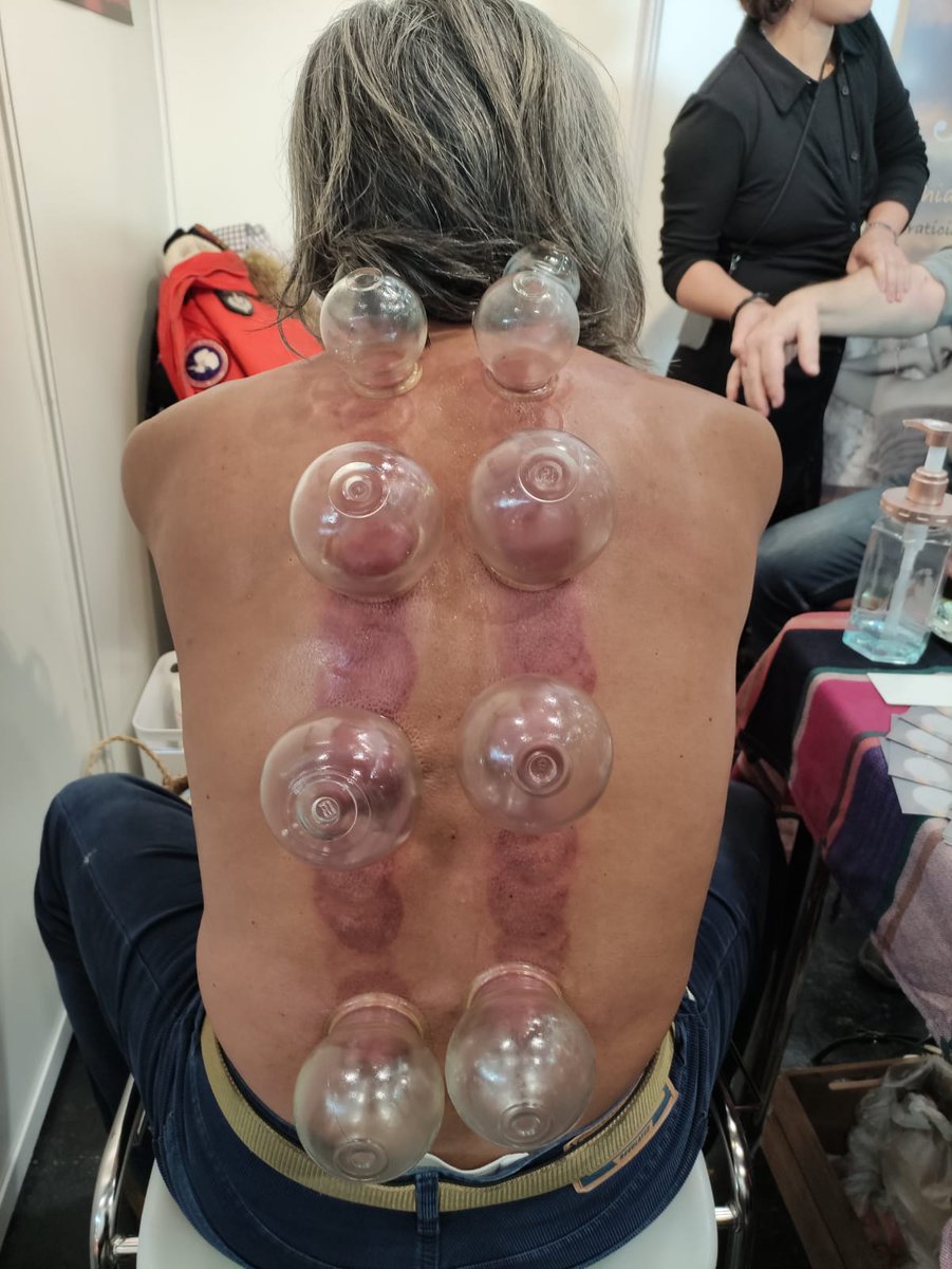 LDCNewsagency's tweet image. 🔴🇫🇷 Pour soulager mes douleurs suite à de violents coups de pied à la tête et à la main gauche dû à une fracture des doigts, thérapie vietnamienne par ventouses puis séance d&apos;acupuncture #bienêtre #medecinedouce #ventouse #ventouses #paris #soin #santé #agressionextrêmegauche