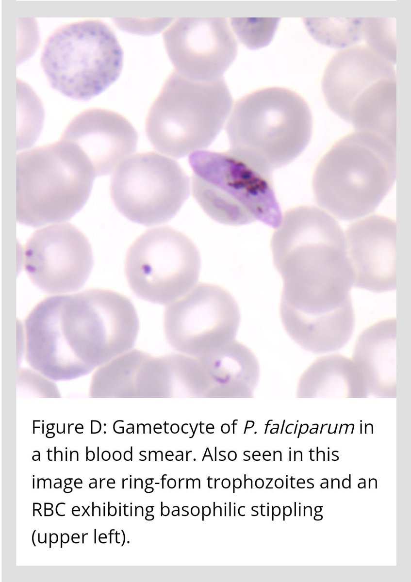 medtechlyfe's tweet photo. Part 3 🔬🩸 #Hematology #Microscopy #MedtechLife #MedtechStudent #StudyTwt https://t.co/ZPPoOQGydM
