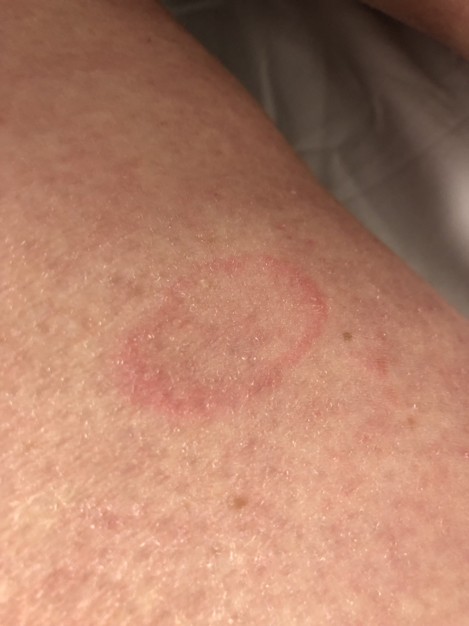 What is this small circular shaped rash? : r/Dermatology