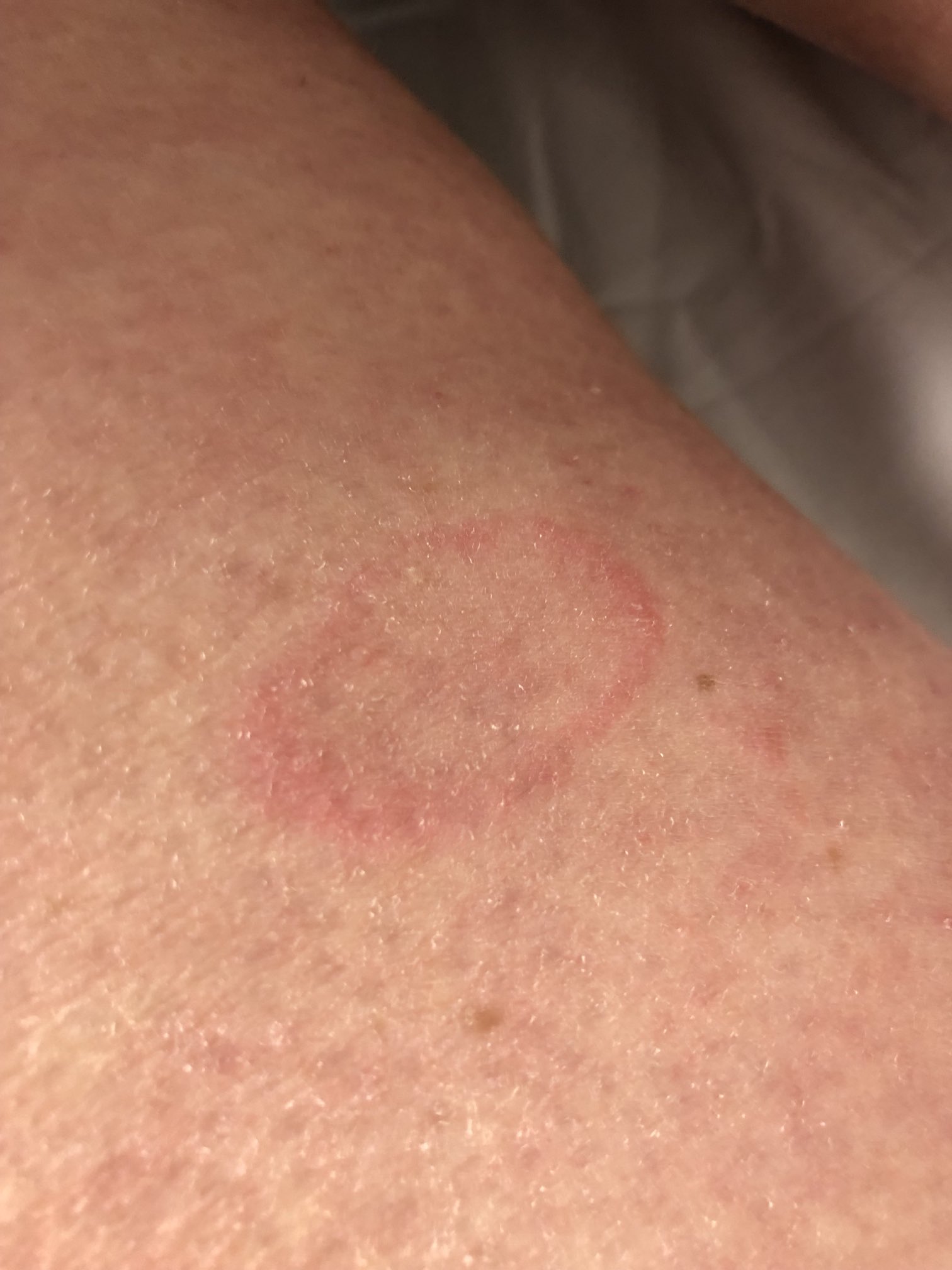 Round Rash On Skin round-rash-on-skin