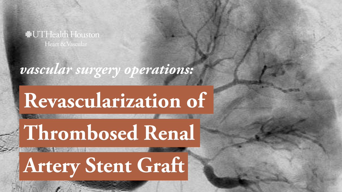Mohammed I. Dairywala, MD (@midairywala) on Twitter photo 🫘 Can kidneys be salvaged after prolonged (>72 hr) warm ischemia?
Here we present revasc of an occluded renal stent s/p Ch-EVAR <a href="/NaveedSaqibMD/">Naveed Saqib</a> <a href="/VascularPlumber/">Tommaso Cambiaghi</a>
🎬 #2 in our new series <a href="/UTHeartVascular/">UTHealth Houston Heart & Vascular</a>
Thanks to our chief <a href="/GustavoOderich/">Gustavo Oderich</a> for his advice on this case! ⬇️ 🫘 Can kidneys be salvaged after prolonged (>72 hr) warm ischemia?
Here we present revasc of an occluded renal stent s/p Ch-EVAR <a href="/NaveedSaqibMD/">Naveed Saqib</a> <a href="/VascularPlumber/">Tommaso Cambiaghi</a>
🎬 #2 in our new series <a href="/UTHeartVascular/">UTHealth Houston Heart & Vascular</a>
Thanks to our chief <a href="/GustavoOderich/">Gustavo Oderich</a> for his advice on this case! ⬇️