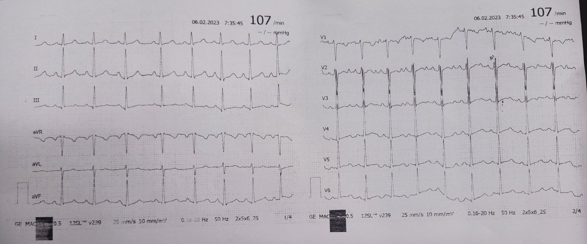 anais_dahoumane's tweet photo. 12years old girl
One episode of syncope
Your thaughts ?
What to do next?
@drahmedmohsen85
@DrRajeshG1 @ecgrhythms #CardioTwitter #ECG #ecglearning https://t.co/zPSdKyGK2h