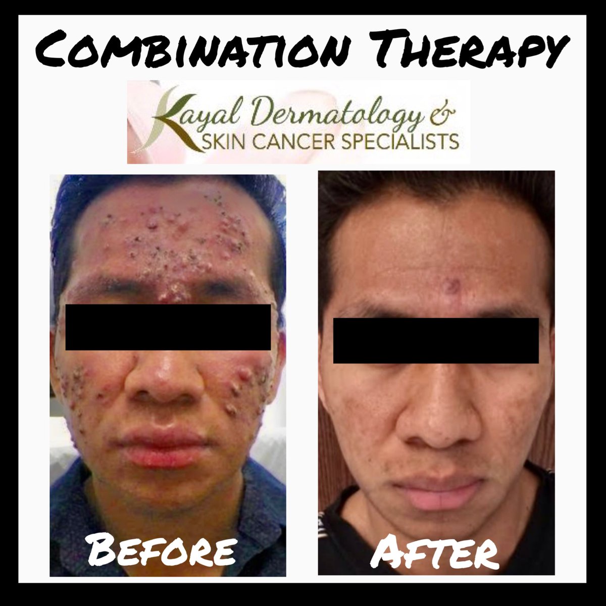 WOW! Check out this result from #CombinationTherapy using #Accutane with Neocutis glycolic cleanser, Revision’s #retinol with #VitaminC and a #VIpeel … Kayal Dermatology & Skin Cancer Specialists @KayalDerm