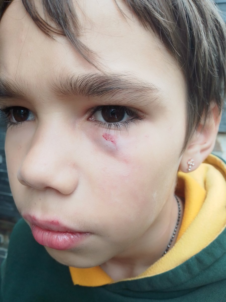 deidre_lovell's tweet photo. Please guys can you keep my little boy James in your prayers he got into an altercation yesterday at school where he was stabbed numerous times in the face by a boy in his class in with a pencil, nothing is going to get done about it apparently at the school 💔😭🙏 https://t.co/LMgKj1nkJa