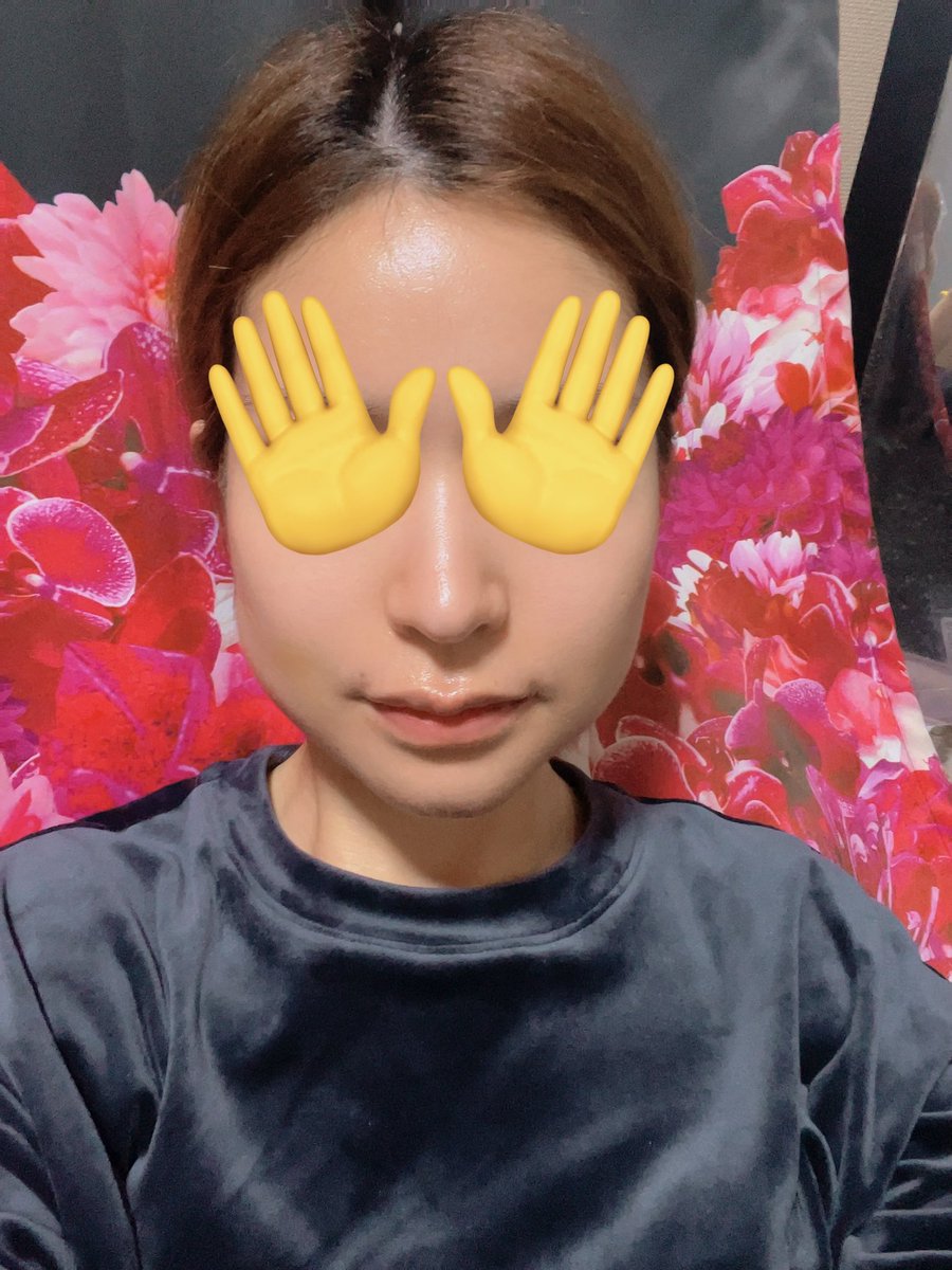 yurichi_638's tweet photo. DT12日目
今日は術後3回目のインディバ行ってきて、だいぶ浮腫も痣も取れた気がする。
左のエラと顎の下の拘縮が凄いから念入りにやってもらいました💆‍♀️

#ビュー美容外科 https://t.co/3SXsLfom5t