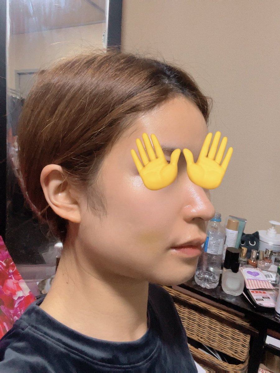 yurichi_638's tweet photo. DT12日目
今日は術後3回目のインディバ行ってきて、だいぶ浮腫も痣も取れた気がする。
左のエラと顎の下の拘縮が凄いから念入りにやってもらいました💆‍♀️

#ビュー美容外科 https://t.co/3SXsLfom5t