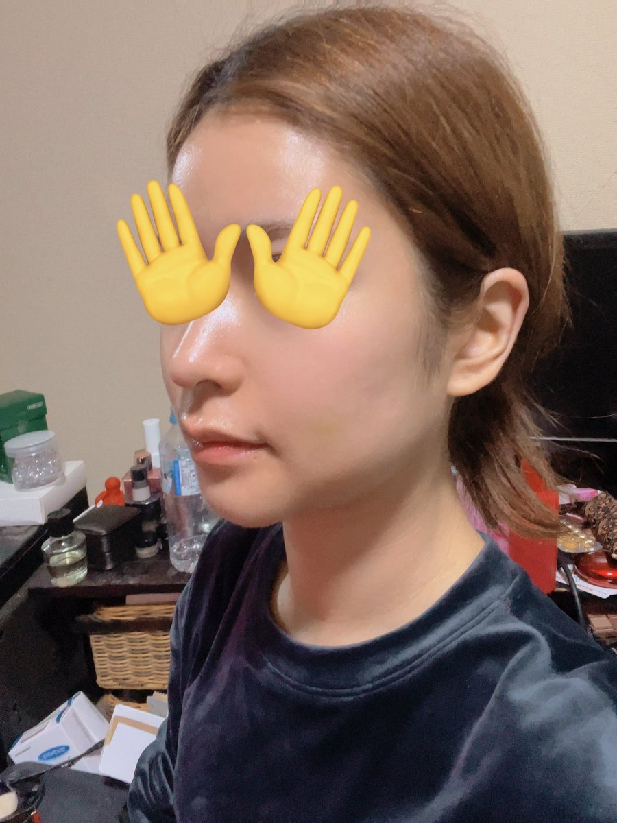 yurichi_638's tweet photo. DT12日目
今日は術後3回目のインディバ行ってきて、だいぶ浮腫も痣も取れた気がする。
左のエラと顎の下の拘縮が凄いから念入りにやってもらいました💆‍♀️

#ビュー美容外科 https://t.co/3SXsLfom5t