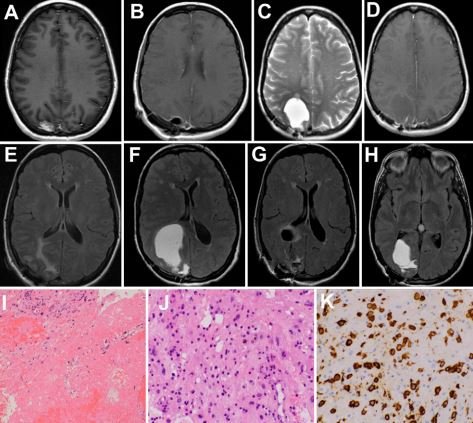 SRS carries a risk of late cyst development in AVMs -  years post treatment - but is the same true for #brainmets? Here we show a similar phenomenon in long-term survivors, a steadily growing population. #cancersurvivorship <a href="/TheJNS/">Journal of Neurosurgery</a> #btsm 

thejns.org/caselessons/vi…