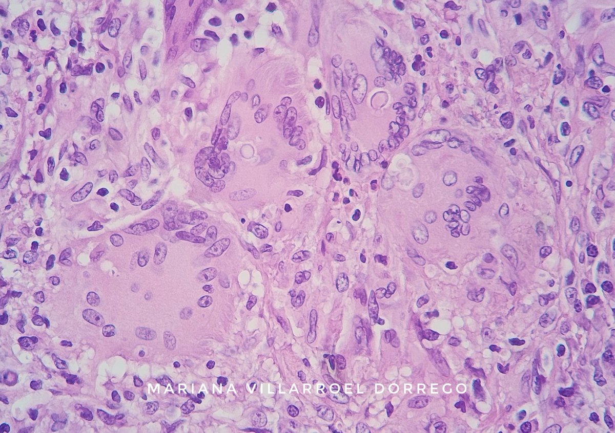 Oral paracoccidioidomycosis 🍄 #oralpath