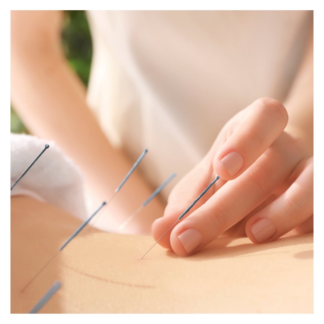 La #acupuntura tiene potentes efectos de neuromodulación: analgésicos, anti-inflamatorios, ansiolíticos y antidepresivos; especialmente eficaz en tratar el #dolor y enfermedades crónicas como la #artrosis y la #tendinitis.

🔵Artículo de #RevistaReuMas:
reumas.org/revista/herram…