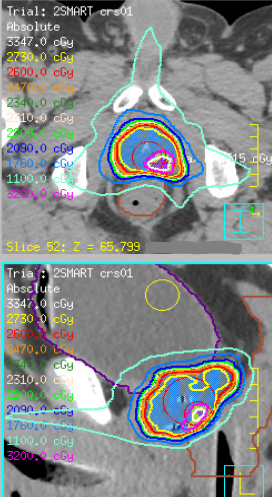 DrAndrewLoblaw's tweet photo. @weeloonong leads our #2SMART medium term outcomes: 26Gy in 2 + microboost (up to 32/2). 2mm margins enabled by #GU-Lok
Feasible and well tolerated! Comparison to 26/2 w/o microboost coming soon
@RadiotherapyOn1 #greenjournal
Link here: https://t.co/gmthbPsYD3 https://t.co/duY42raYSQ