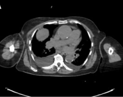 Not every “lung mass” should be biopsied. We shouldn’t see everything as a nail just because we have a hammer. An 80-Year-Old Woman With Dyspnea and a Lung Mass  sciencedirect.com/science/articl…