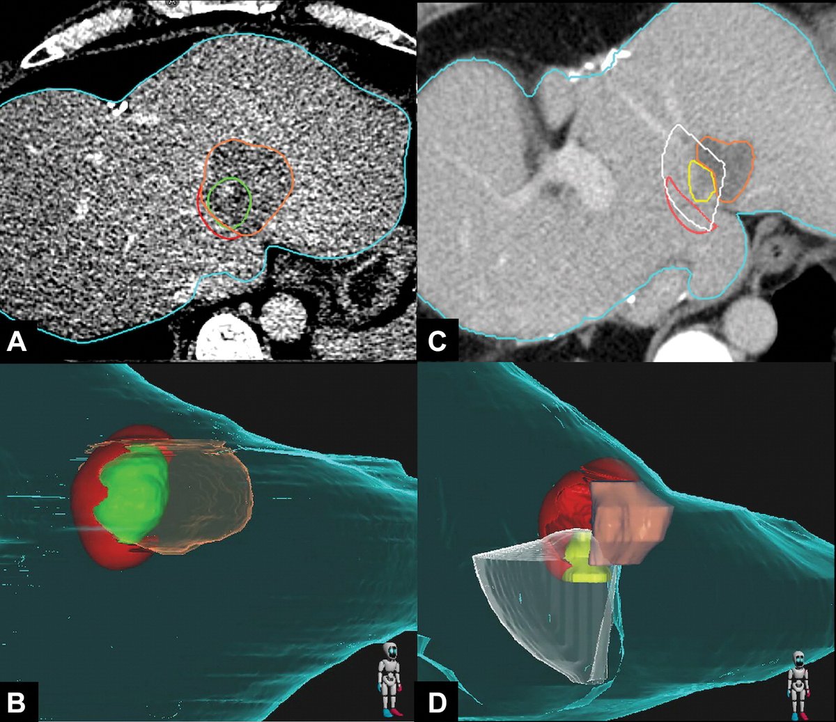 Radiology (@radiology_rsna) on Twitter photo Ablative margin quantified using biomechanical deformable CT image registration with autosegmentation was strongly associated and spatially localized with local disease progression after colorectal liver metastasis ablation. @BC_Odisio <a href="/MDAndersonNews/">MD Anderson Cancer Center</a> bit.ly/3Y8Rosr Ablative margin quantified using biomechanical deformable CT image registration with autosegmentation was strongly associated and spatially localized with local disease progression after colorectal liver metastasis ablation. @BC_Odisio <a href="/MDAndersonNews/">MD Anderson Cancer Center</a> bit.ly/3Y8Rosr