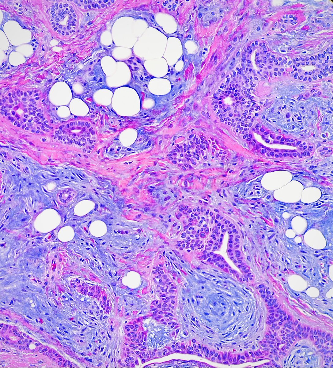 Cutaneous counterpart of pleomorphic adenoma of salivary gland? #dermpath #dermtwitter #Pathresidents #MedTwitter #PathTwitter #pathologists answer kikoxp.com/posts/20927