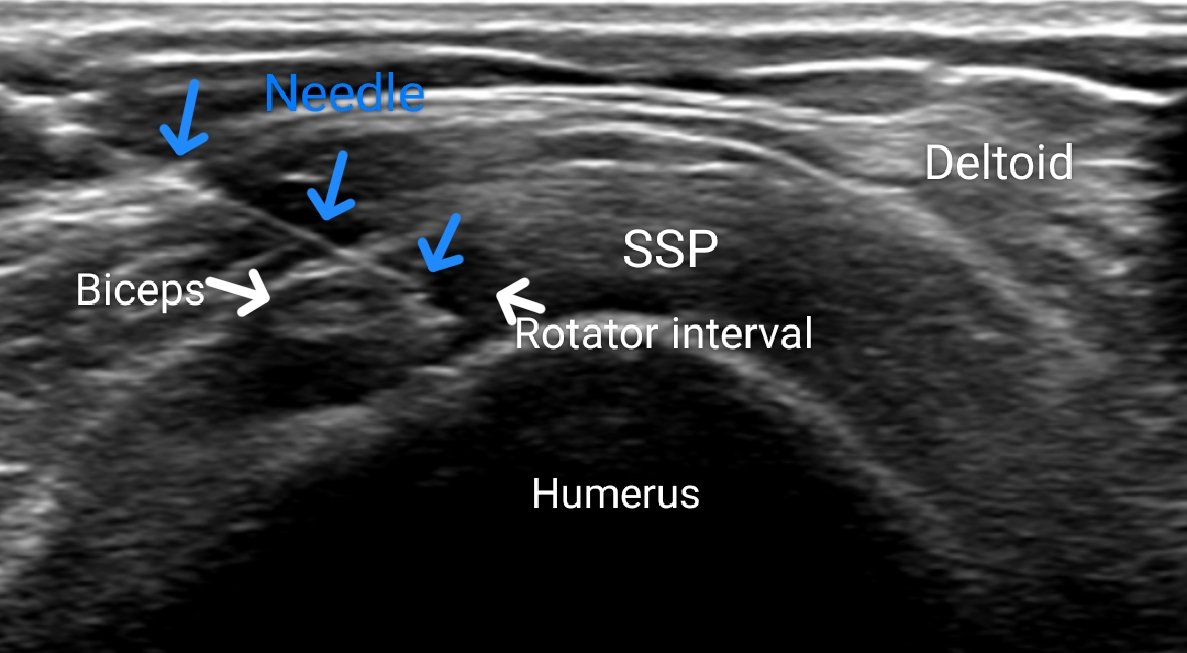 ASK_MSK's tweet image. As a MSK Rad Hydrodilatation for adhesive capsulitis is one of the most gratifying procedures, seeing a patient with chronic pain &amp;amp; stiffness smile after getting instant relief and mobility is the best!

A 🧵 on Hydrodilatation

#radres #radtwitter #MedTwitter #FOAMrad #FOAMed