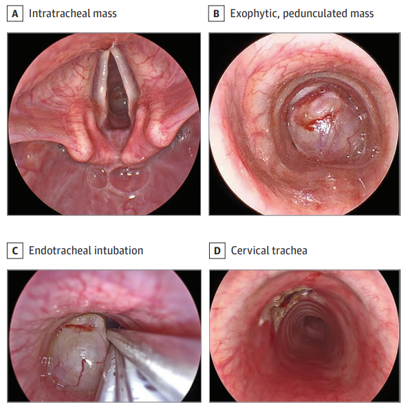 A 12-yo girl presented with a 3-mo history of intermittent stridor; her symptoms were initially most prominent while playing sports and were suspected to be due to asthma or seasonal allergies. Take the Clinical Challenge. What is your diagnosis? ja.ma/3Y2Hpp0
