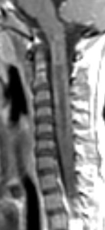 Tip of the day 💡: Heterogeneous, expanded, enhancing along the margins, much edema....yes, agree!...but worth checking AQP4 antibody status- might save the child a biopsy or debulking surgery! Brain and optic nerves were normal in this case. Final diagnosis: AQP4-neuromyelitis.