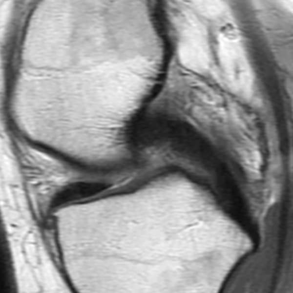 RadsourceLLC's tweet photo. In this month’s Radsource MRI Web Clinic, Dr. Mark Awh discusses an under-recognized anatomical variant of the knee that may result in diagnostic pitfalls for the uninitiated. #radiology #mri #medicalimaging
https://t.co/U29yk3NYRZ https://t.co/mU00UcgTrn